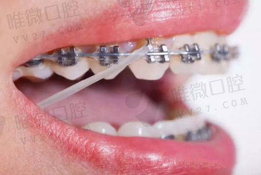 科普,拔烂牙多少钱一颗啊（烂牙根拔了太舒服了）(图1)